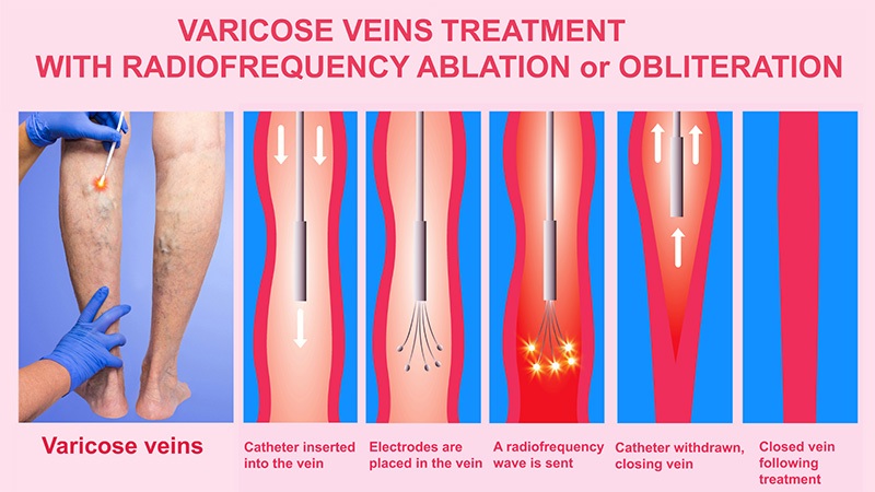 Endoluminal ablation