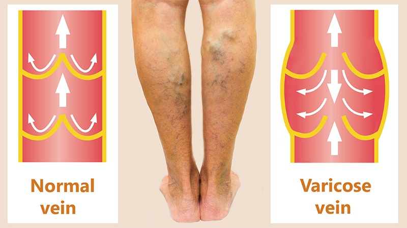 Varicose vein