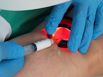 Arturo performing foam sclero