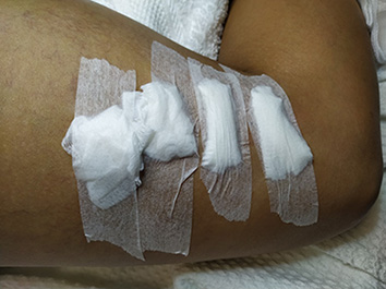 Swabs after foam sclero