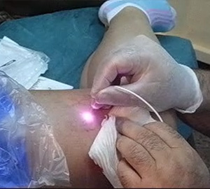 percutaneous laser