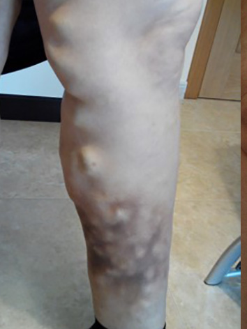 severe varicose veins