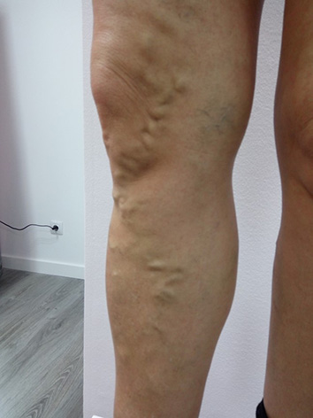 varicose veins